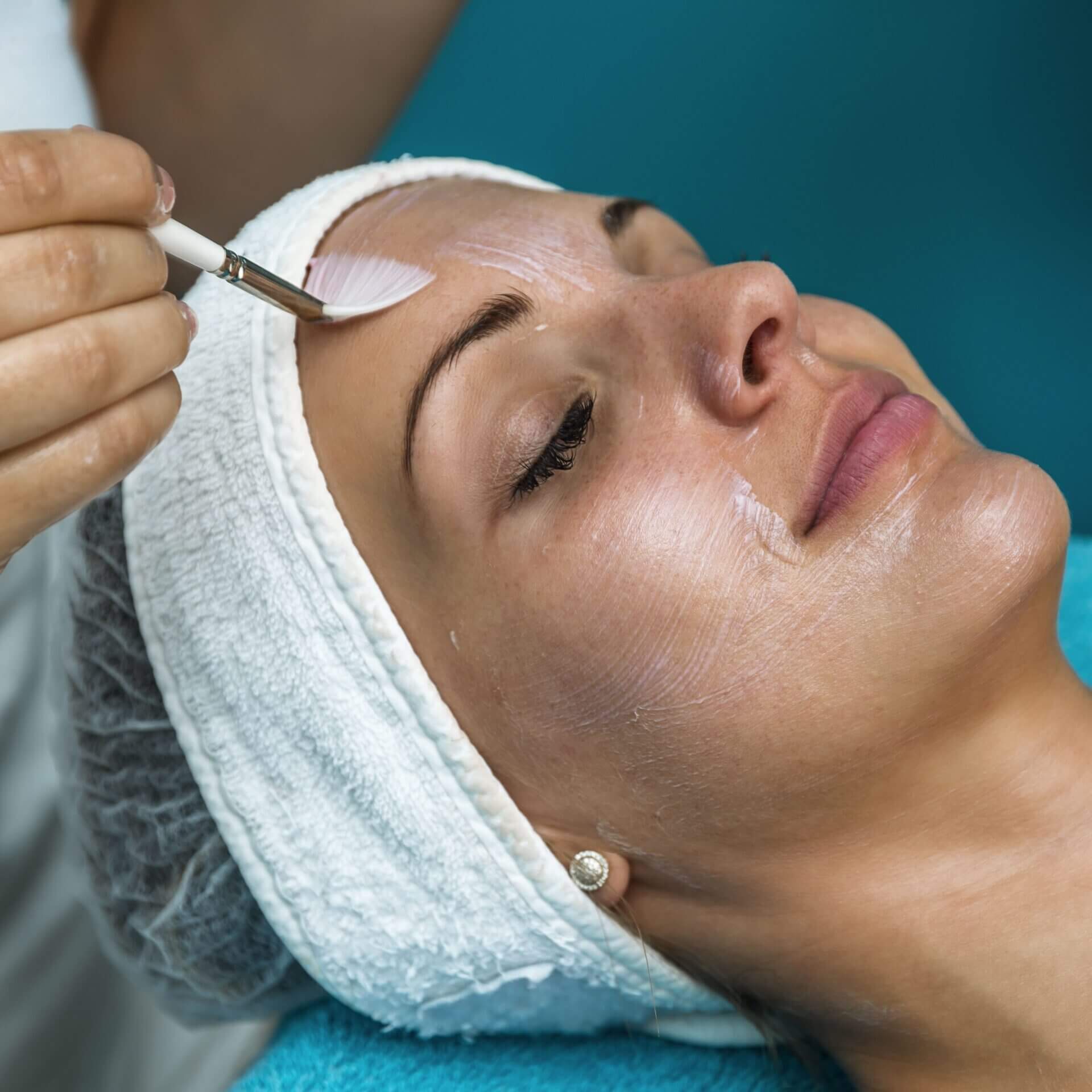 Chemical Peel-min
