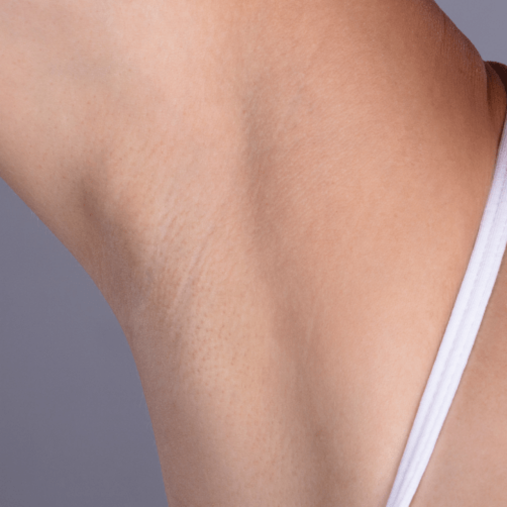 Laser Hair Removal Suffolk