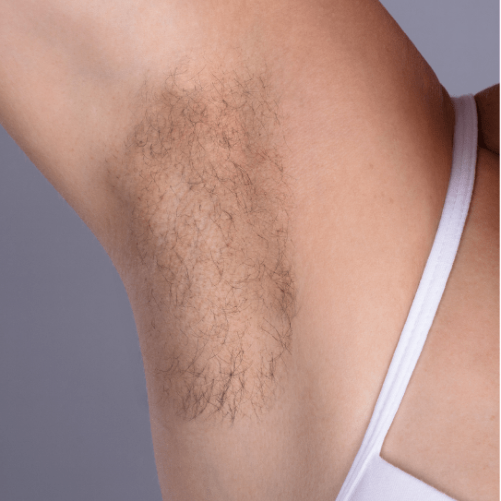 Laser Hair Removal Suffolk