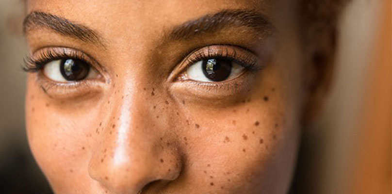 Hyperpigmentation-and-Melasma | Care Access Clinic | Cosmetic & Primary Care Clinic in Babylon NY