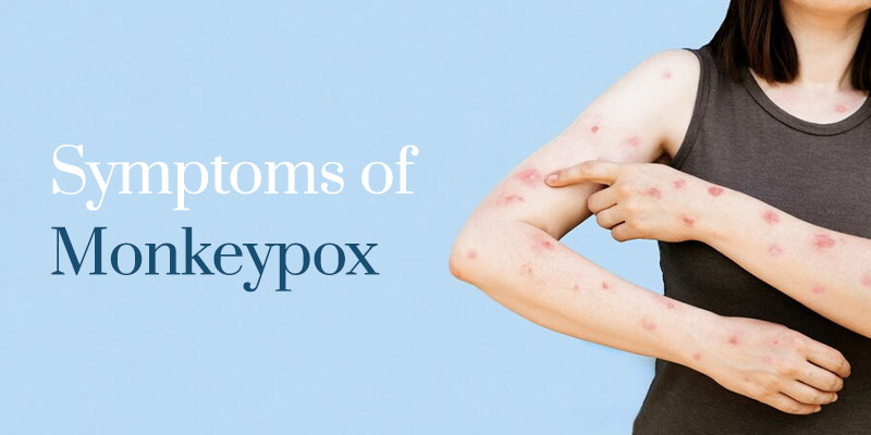 Symptoms-of-Monkeypox | Care Access Clinc