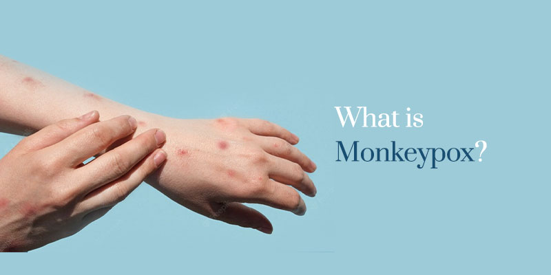 What-is-Monkeypox | Care Access Clinc