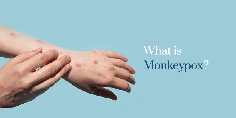 What-is-Monkeypox | Care Access Clinc